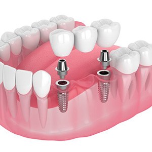Illustration of dental implants with bridge