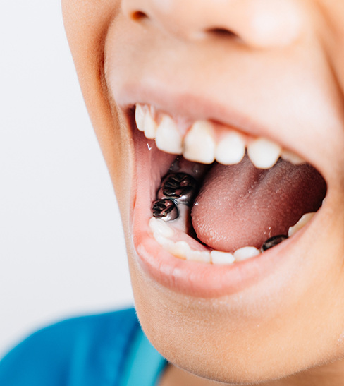 Child opening mouth to show metal dental restorations