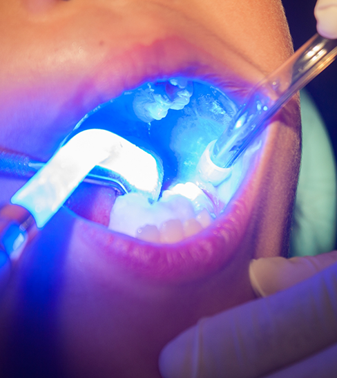 Close-up of dental sealants being applied to children's teeth