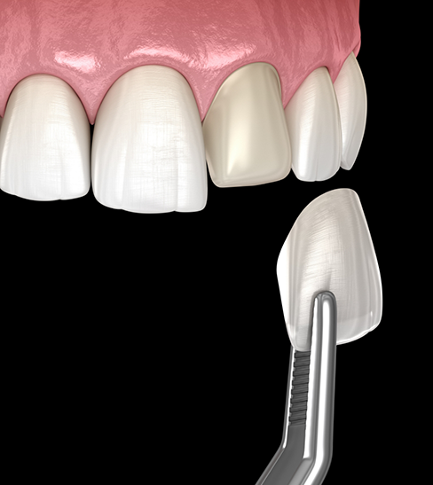 Illustration of veneer being placed on front tooth