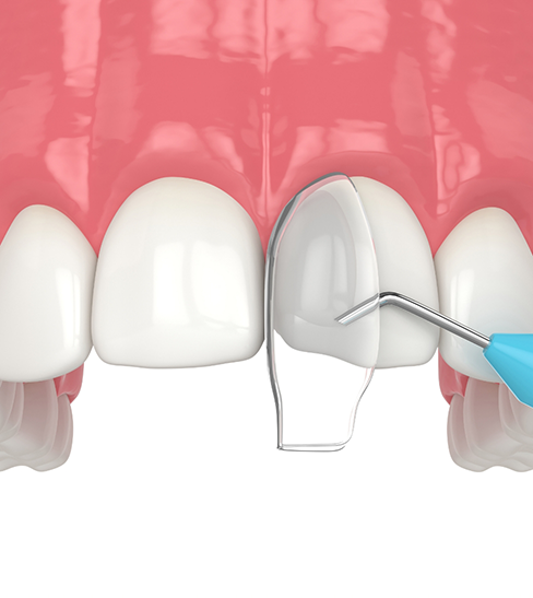 Illustration of cosmetic bonding for front teeth in upper arch