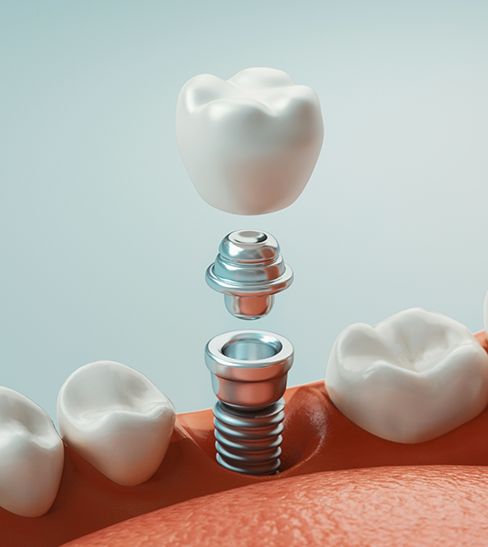 Illustration of dental implant in Fort Worth and crown being inserted into lower arch