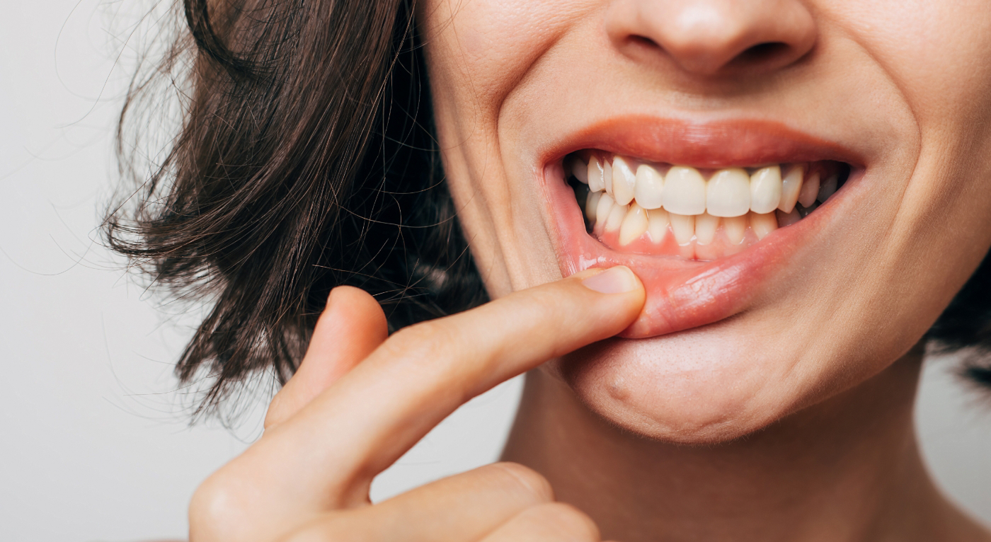 Close-up of person pulling down lip to show gums