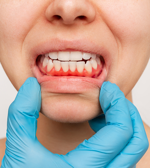 Gloved hands pulling down lips to show gum disease