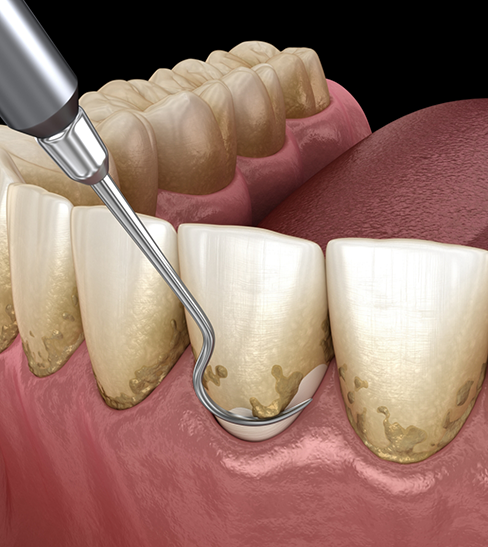 Illustration of scaling and root planing for gum disease treatment in Fort Worth