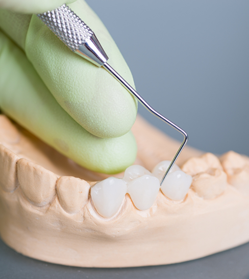 Using exploratory tool to examine dental bridge on model of teeth