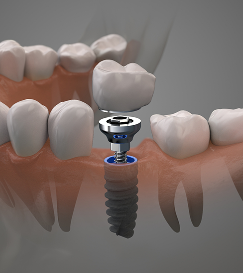 Illustration of dental implant, abutment, and crown being placed