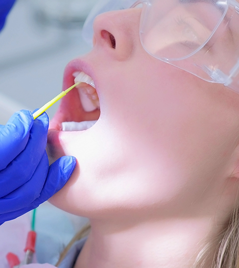 Close-up of fluoride being applied to female patient's upper teeth