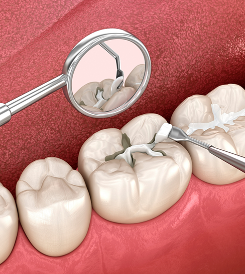 Illustration of tooth-colored filling being applied to tooth