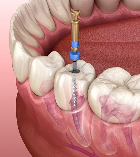 Illustration of root canal treatment in Fort Worth for tooth in lower arch