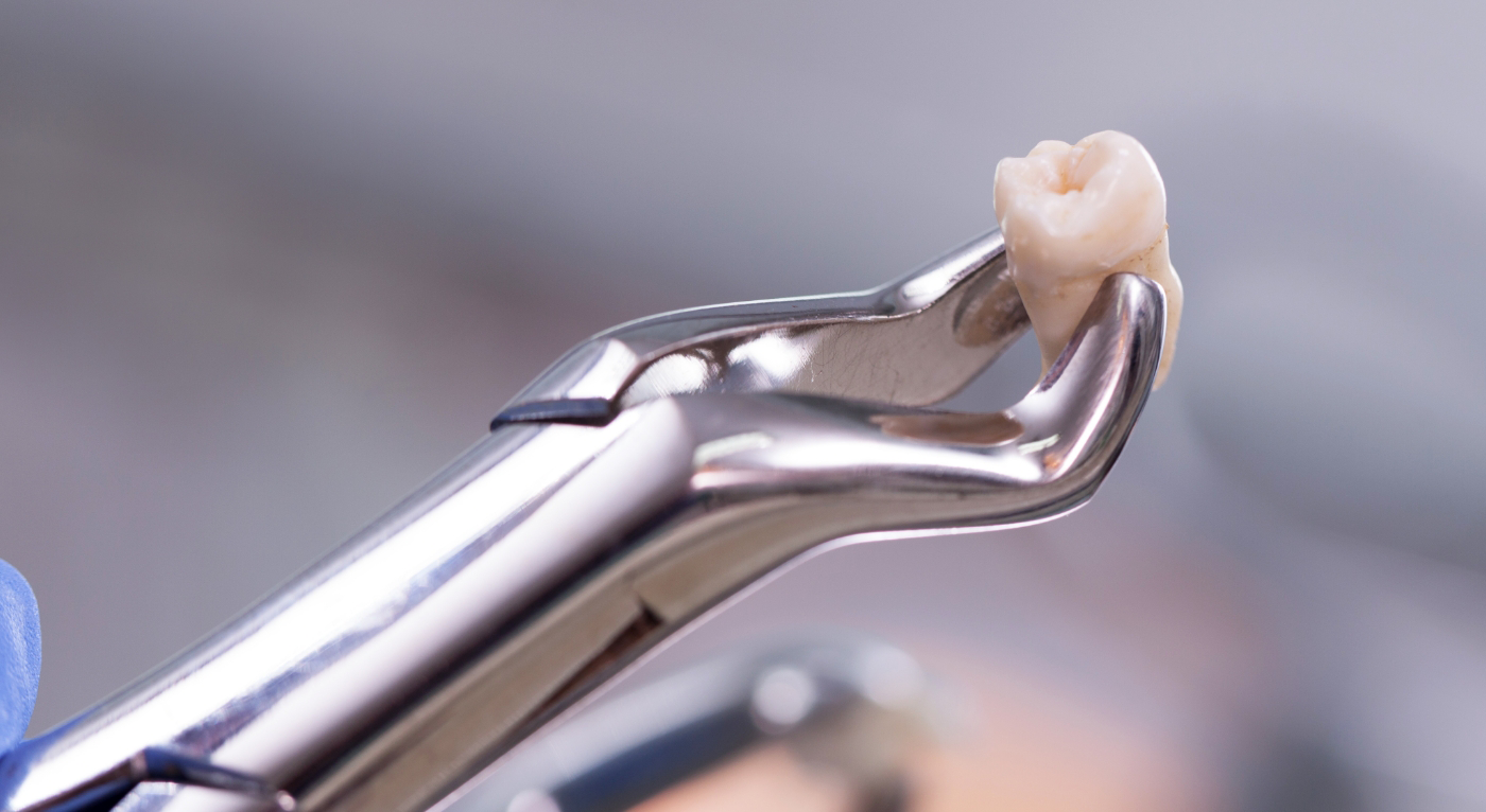 Forceps holding a tooth after a tooth extraction in Fort Worth