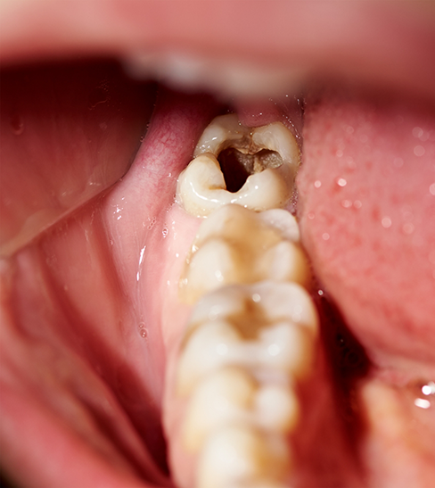 Close-up of badly decayed teeth in mouth