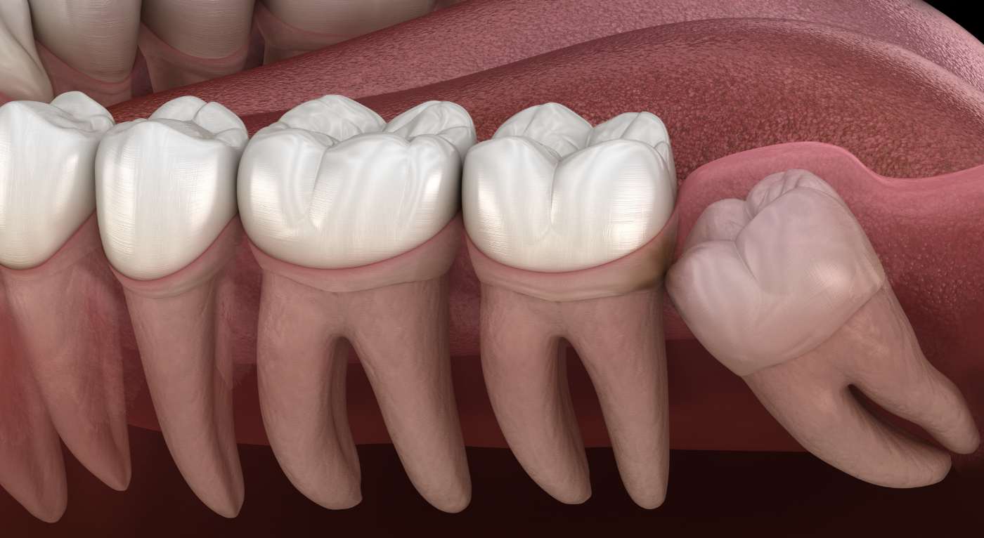 Illustration of an impacted wisdom tooth